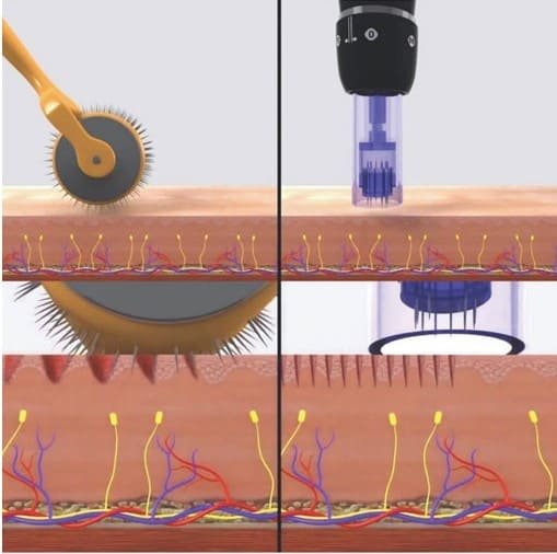 Dermapen-Versus-Dermaroller