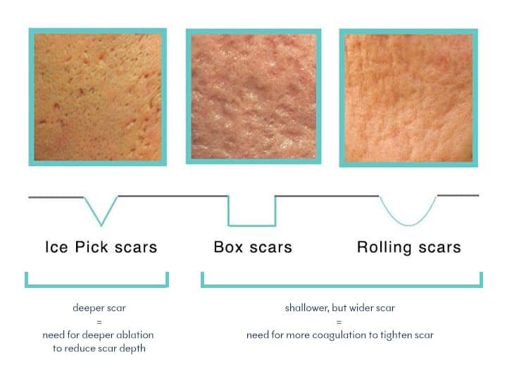 laser treatment for acne scars malaysia