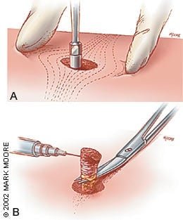 skin grafting