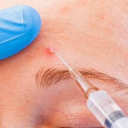Acne - intra-lesion injection Acne - intra-lesion injection - True Clinic Kota Damansara