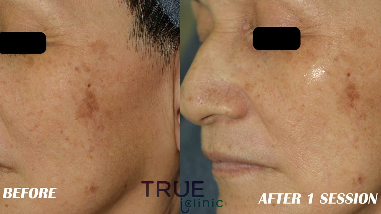 Face treatment PRE AND POST