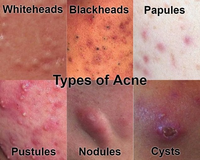 acne treatment (whiteheads, blackheads, papules, pustules, nodules, cysts) treatment kl malaysia