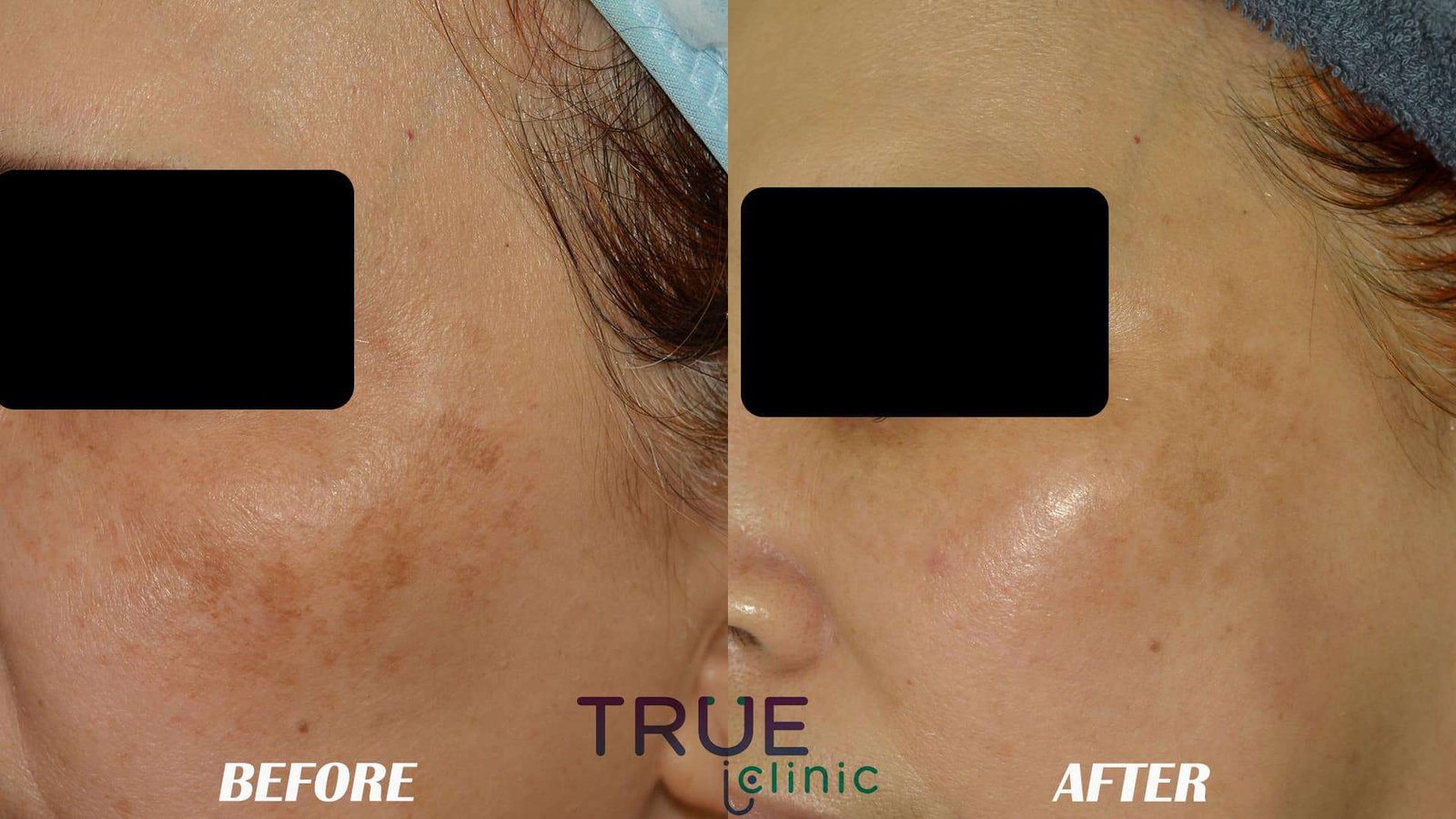 Face treatment PRE AND POST damansara