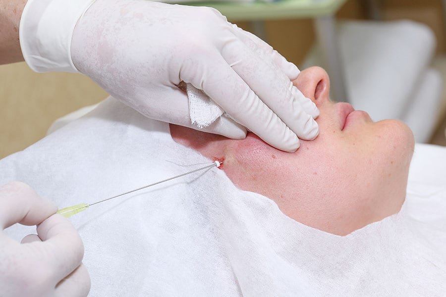 Face Thread Lifting Service at True Clinic KL