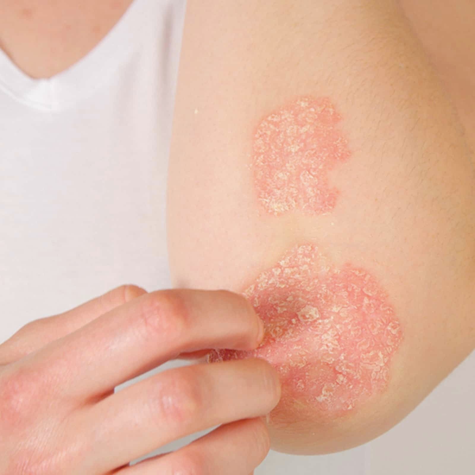 List Of Most Common Skin Diseases