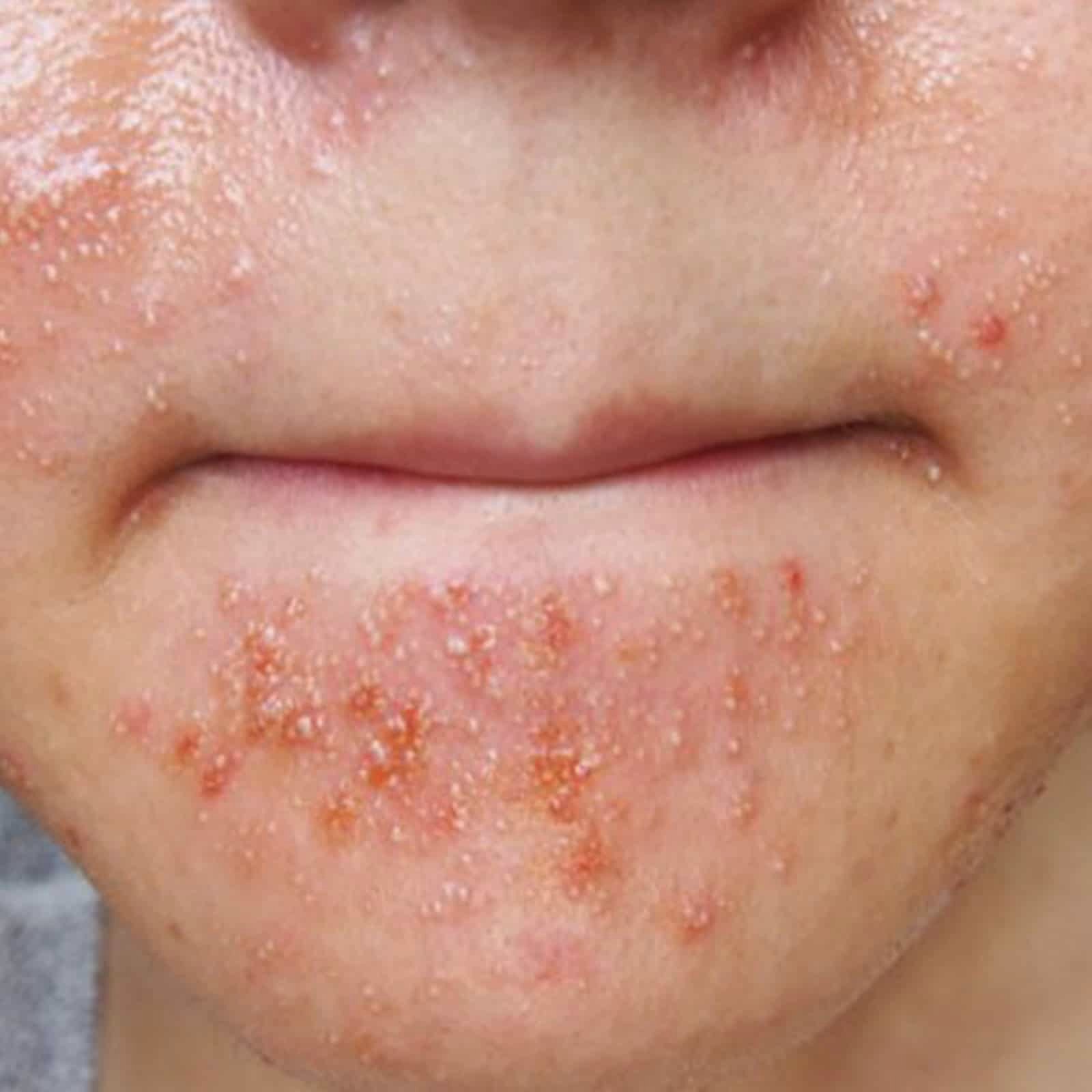 Common Skin Disease True Clinic