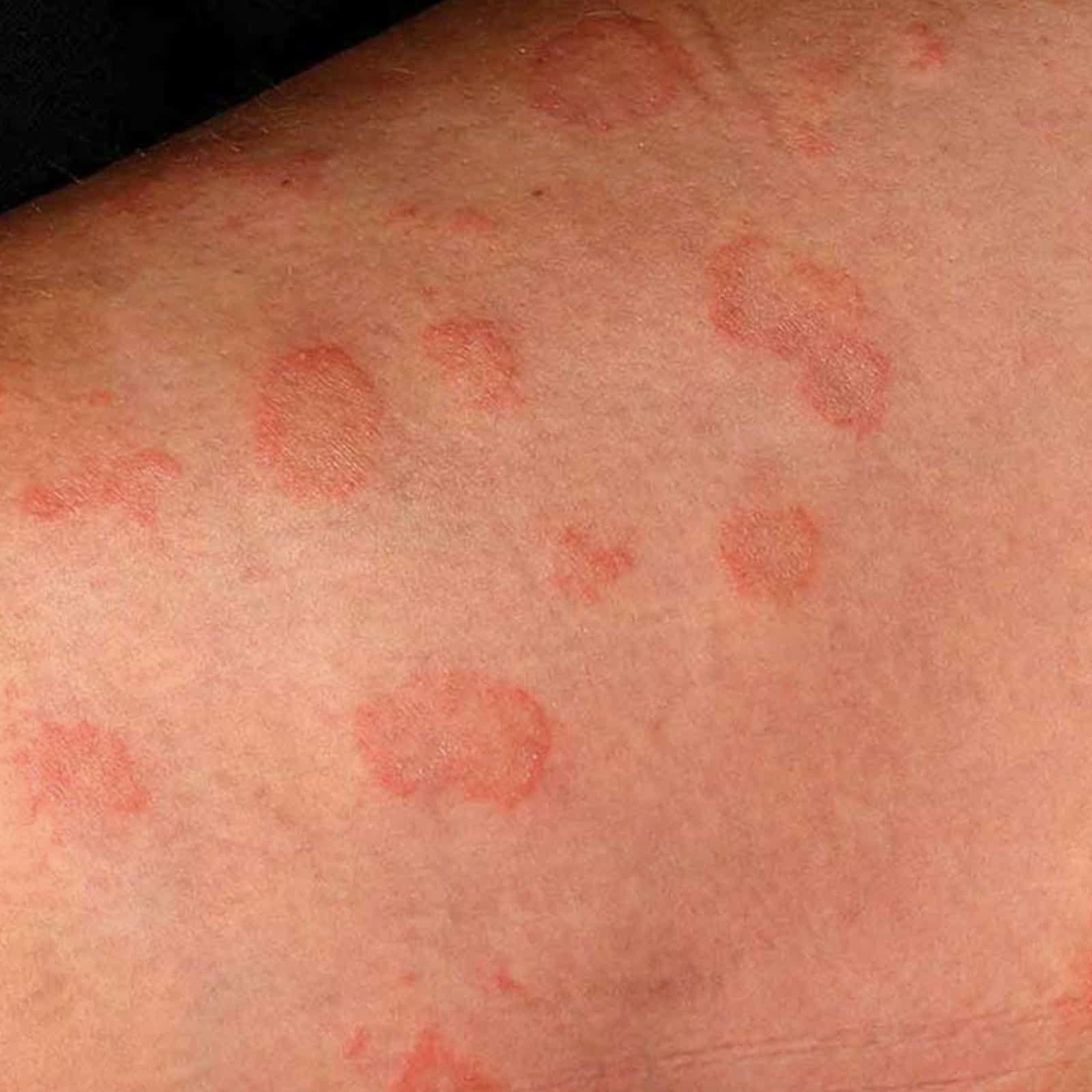 pictures-of-skin-infections