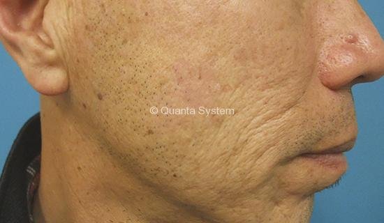 Benign Pigmented Lesions - after Benign Pigmented Lesions - after
