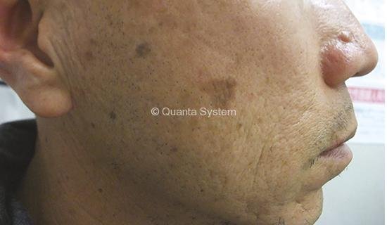 Benign Pigmented Lesions - before Benign Pigmented Lesions - before