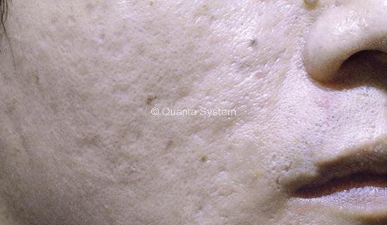 skin resurfacing - after skin resurfacing - after