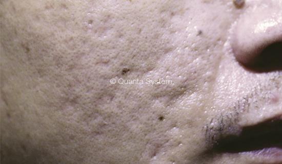 skin resurfacing - before skin resurfacing - before