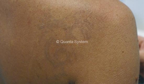 Tattoo Removal After Pico Laser Tattoo Removal After Pico Laser